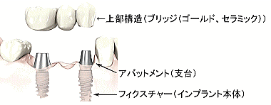 �C���v�����g�̍\���i�u���b�W�j