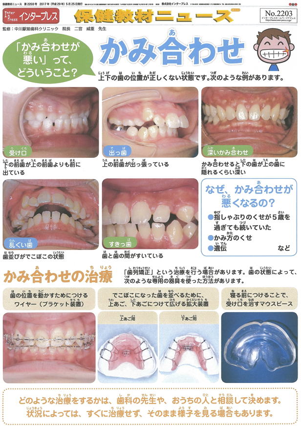 かみ合わせ