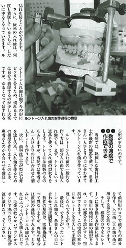 ノンクラスプデンチャー記事４