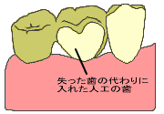�u���b�W