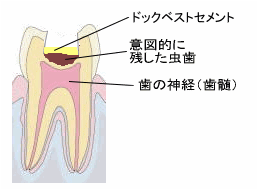 ドックベストセメント3