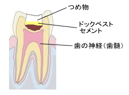 ドックベストセメント4