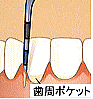 歯周ポケットの測定