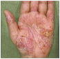 掌蹠膿疱症の症状（手）