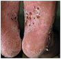 掌蹠膿疱症の症状（足）