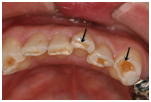歯軋りによる歯の摩耗