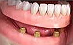 インプラント義歯（ロケータータイプ）
