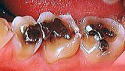 奥歯の酸蝕歯