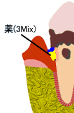 歯周病治療における３Mix法　２