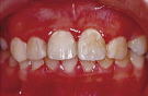 歯の清掃不良による全体的な歯肉炎