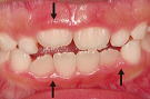 歯の萌出に伴う歯肉炎