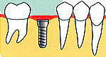 インプラントは歯肉に覆われています