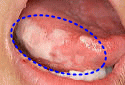 放射線治療による口腔粘膜炎（舌）