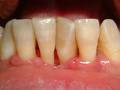歯周病の歯茎
