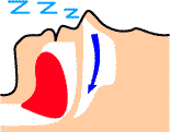 いびき、睡眠時無呼吸症候群の状態